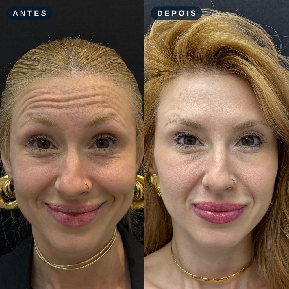 Antes e depois - Toxina Botulínica