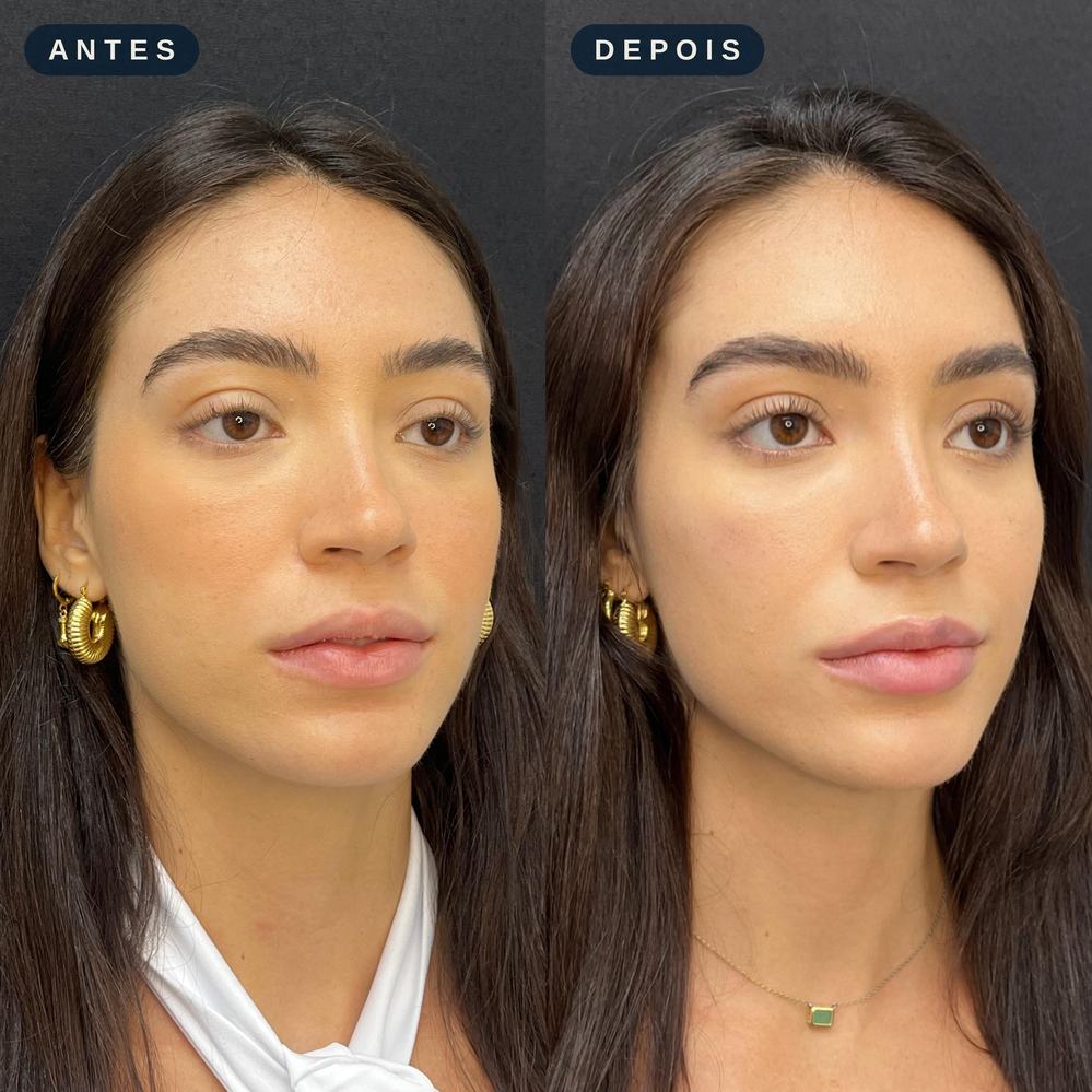 Antes e depois - Preenchimento Facial