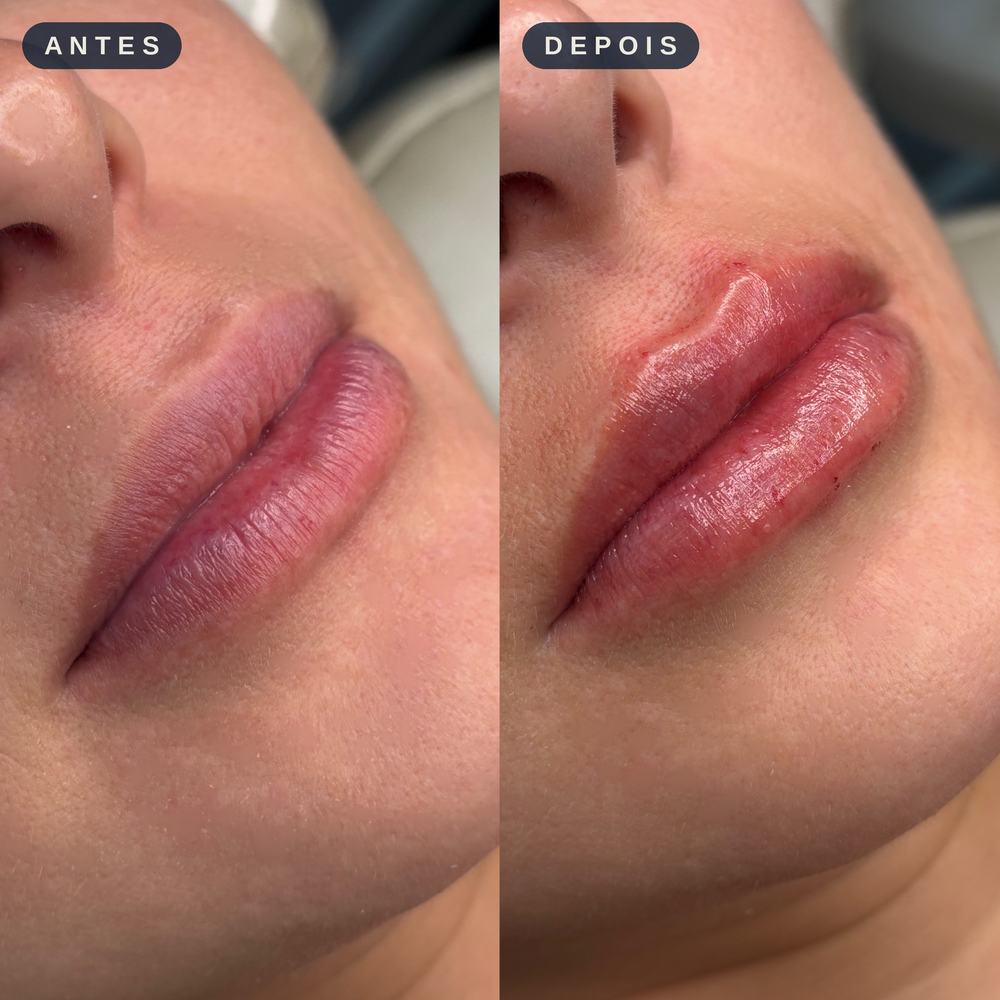 Antes e depois - Preenchimento Labial