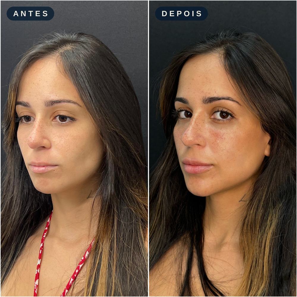 Antes e depois - Preenchimento Facial