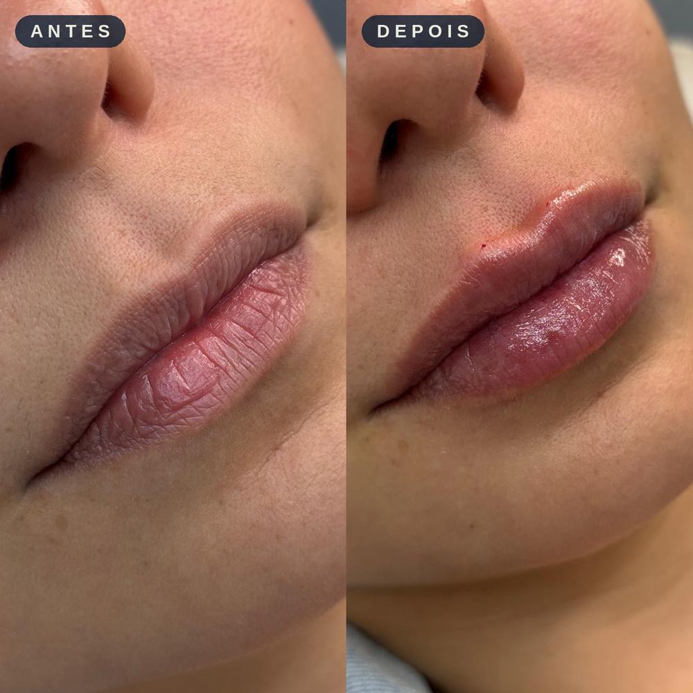 Antes e depois - Preenchimento Labial