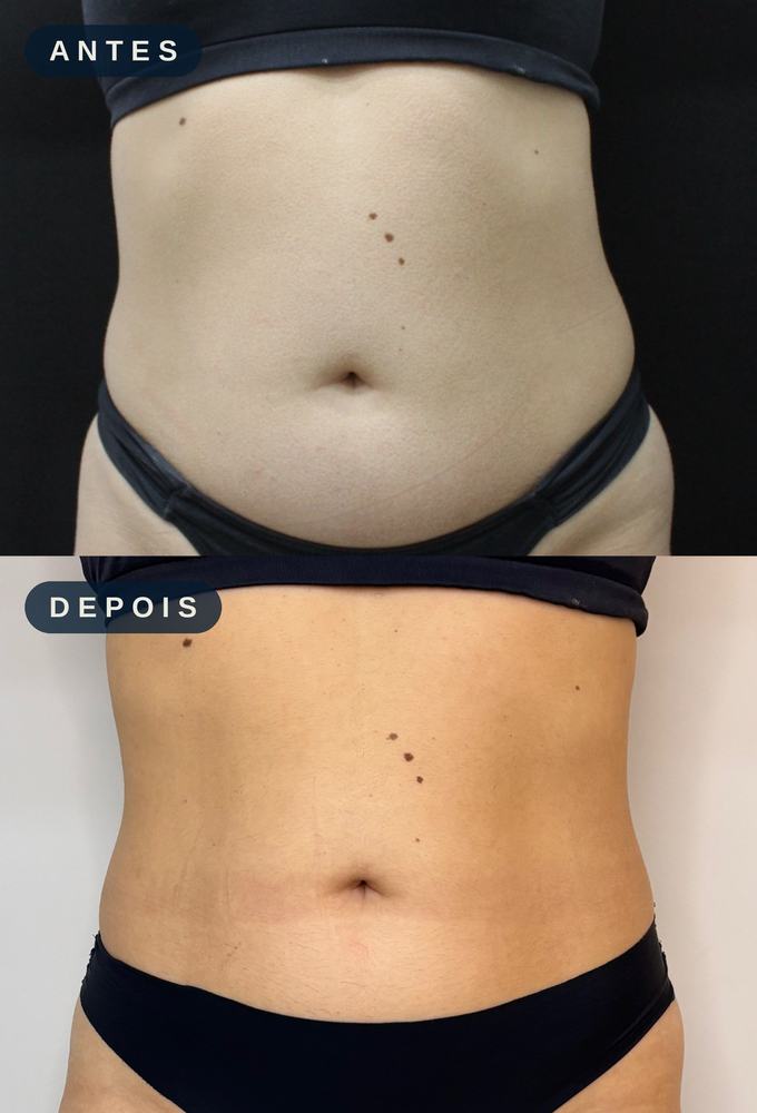 Antes e depois - Ultrassom Macrofocado